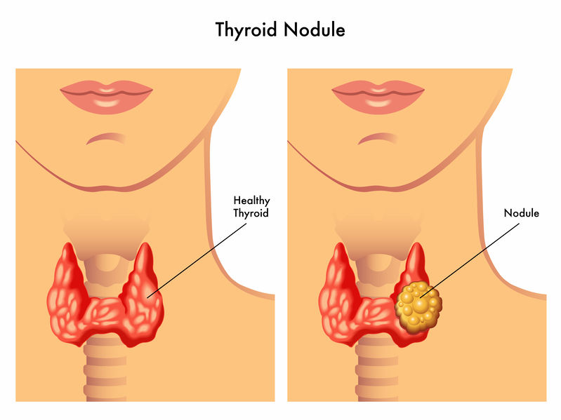 Información sobre la Tiroides